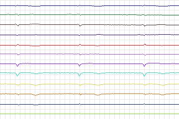 Electrocardiogram for PTB Diagnostic ECG, record s0117lre-patient030