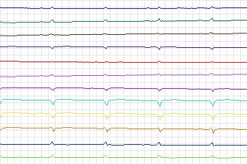 Electrocardiogram for PTB Diagnostic ECG, record s0118lre-patient034