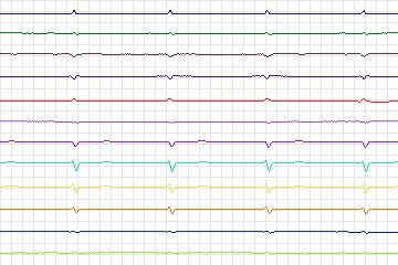 Electrocardiogram for PTB Diagnostic ECG, record s0119lre-patient035