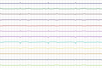 Electrocardiogram for PTB Diagnostic ECG, record s0120lre-patient037