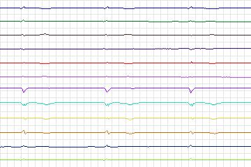 Electrocardiogram for PTB Diagnostic ECG, record s0121lre-patient033