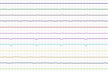 Electrocardiogram for PTB Diagnostic ECG, record s0122lre-patient029