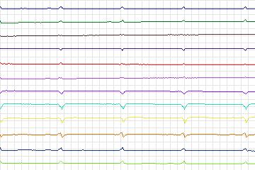 Electrocardiogram for PTB Diagnostic ECG, record s0123lre-patient034
