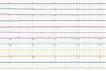 Electrocardiogram for PTB Diagnostic ECG, record s0124lre-patient035