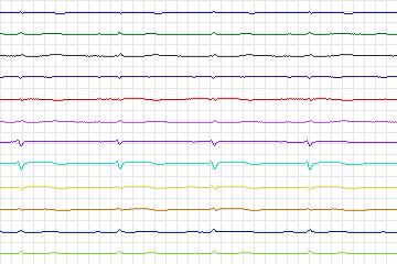 Electrocardiogram for PTB Diagnostic ECG, record s0125lre-patient038