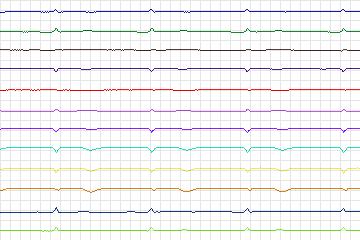 Electrocardiogram for PTB Diagnostic ECG, record s0126lre-patient036