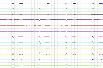 Electrocardiogram for PTB Diagnostic ECG, record s0127lre-patient031