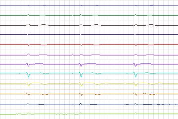 Electrocardiogram for PTB Diagnostic ECG, record s0128lre-patient038