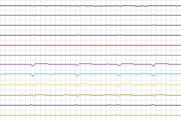 Electrocardiogram for PTB Diagnostic ECG, record s0129lre-patient039