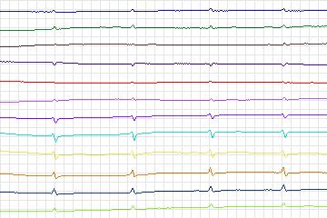 Electrocardiogram for PTB Diagnostic ECG, record s0130lre-patient040