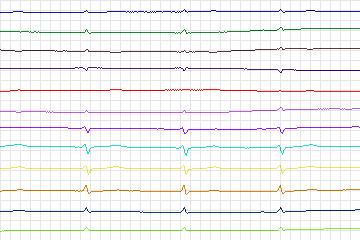 Electrocardiogram for PTB Diagnostic ECG, record s0131lre-patient040