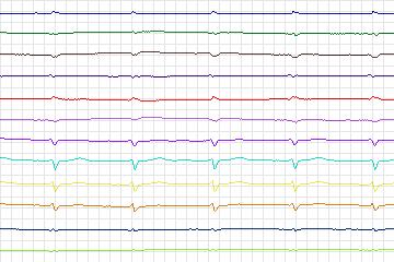 Electrocardiogram for PTB Diagnostic ECG, record s0132lre-patient041