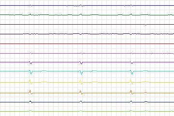 Electrocardiogram for PTB Diagnostic ECG, record s0133lre-patient040