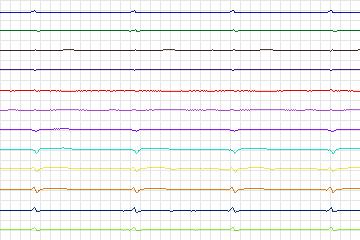 Electrocardiogram for PTB Diagnostic ECG, record s0134lre-patient039