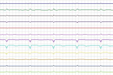 Electrocardiogram for PTB Diagnostic ECG, record s0135lre-patient042