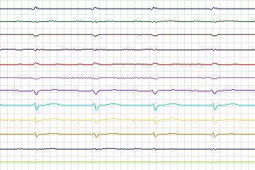 Electrocardiogram for PTB Diagnostic ECG, record s0136lre-patient041