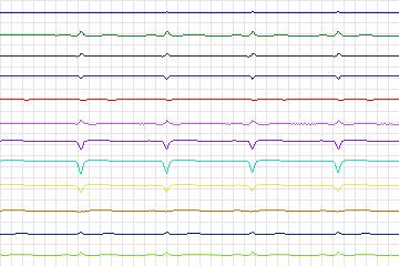 Electrocardiogram for PTB Diagnostic ECG, record s0137lre-patient042