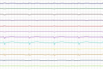 Electrocardiogram for PTB Diagnostic ECG, record s0138lre-patient041