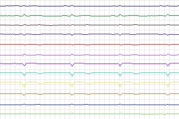 Electrocardiogram for PTB Diagnostic ECG, record s0140lre-patient042