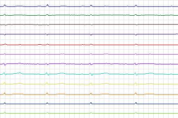 Electrocardiogram for PTB Diagnostic ECG, record s0141lre-patient043