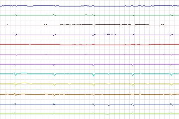 Electrocardiogram for PTB Diagnostic ECG, record s0142lre-patient044