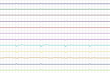 Electrocardiogram for PTB Diagnostic ECG, record s0143lre-patient044