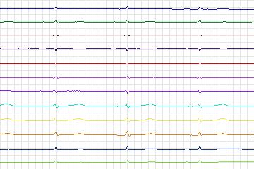 Electrocardiogram for PTB Diagnostic ECG, record s0144lre-patient043