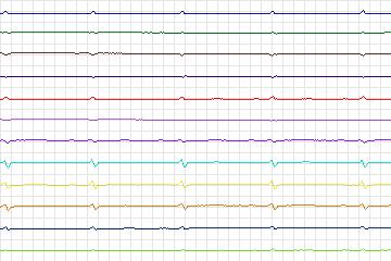 Electrocardiogram for PTB Diagnostic ECG, record s0145lre-patient035
