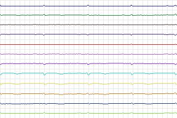 Electrocardiogram for PTB Diagnostic ECG, record s0146lre-patient044