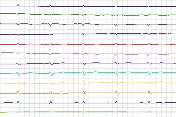 Electrocardiogram for PTB Diagnostic ECG, record s0147lre-patient045