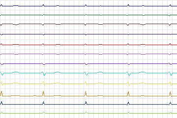 Electrocardiogram for PTB Diagnostic ECG, record s0148lre-patient045