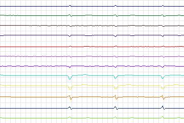 Electrocardiogram for PTB Diagnostic ECG, record s0150lre-patient025