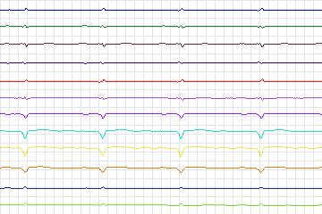 Electrocardiogram for PTB Diagnostic ECG, record s0151lre-patient027