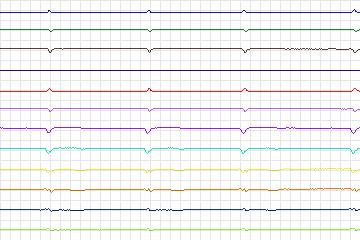 Electrocardiogram for PTB Diagnostic ECG, record s0153lre-patient030