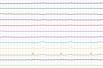 Electrocardiogram for PTB Diagnostic ECG, record s0155lre-patient045