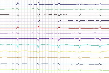 Electrocardiogram for PTB Diagnostic ECG, record s0156lre-patient046