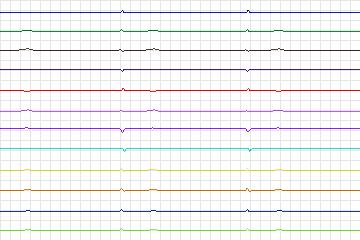 Electrocardiogram for PTB Diagnostic ECG, record s0157lre-patient033
