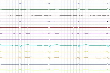 Electrocardiogram for PTB Diagnostic ECG, record s0158lre-patient034