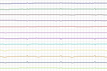 Electrocardiogram for PTB Diagnostic ECG, record s0159lre-patient044