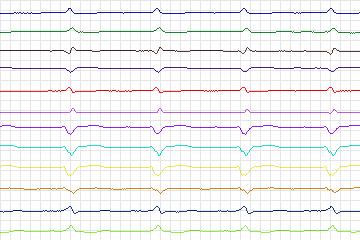 Electrocardiogram for PTB Diagnostic ECG, record s0160lre-patient047