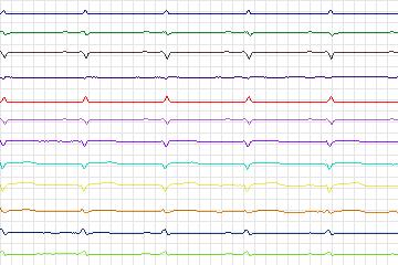 Electrocardiogram for PTB Diagnostic ECG, record s0161lre-patient046
