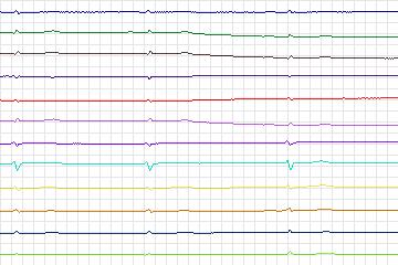 Electrocardiogram for PTB Diagnostic ECG, record s0162lre-patient038
