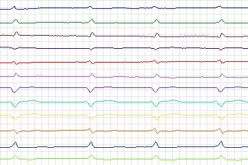 Electrocardiogram for PTB Diagnostic ECG, record s0163lre-patient047