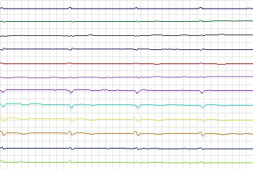 Electrocardiogram for PTB Diagnostic ECG, record s0164lre-patient039