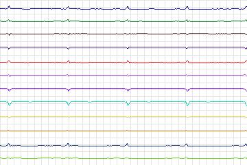 Electrocardiogram for PTB Diagnostic ECG, record s0165lre-patient032