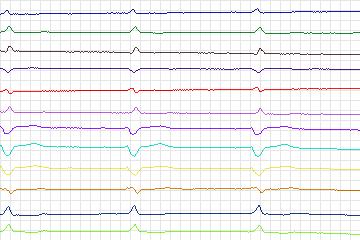Electrocardiogram for PTB Diagnostic ECG, record s0167lre-patient047