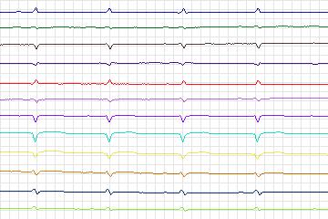 Electrocardiogram for PTB Diagnostic ECG, record s0168lre-patient046