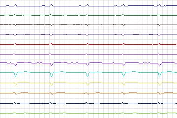 Electrocardiogram for PTB Diagnostic ECG, record s0171lre-patient048