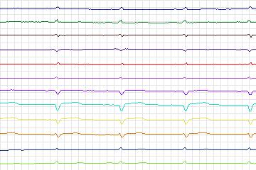 Electrocardiogram for PTB Diagnostic ECG, record s0172lre-patient048