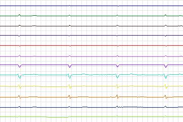 Electrocardiogram for PTB Diagnostic ECG, record s0173lre-patient049